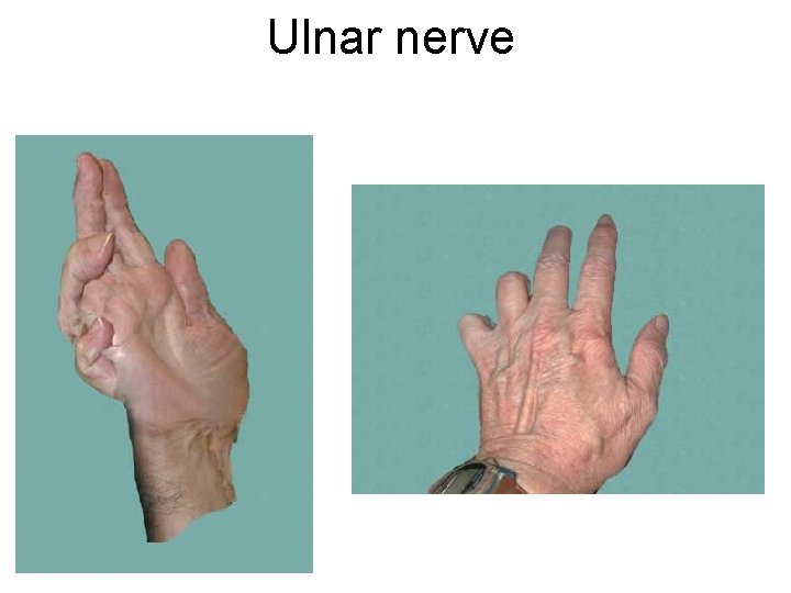 Ulnar nerve 