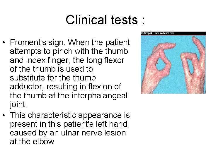 Clinical tests : • Froment's sign. When the patient attempts to pinch with the