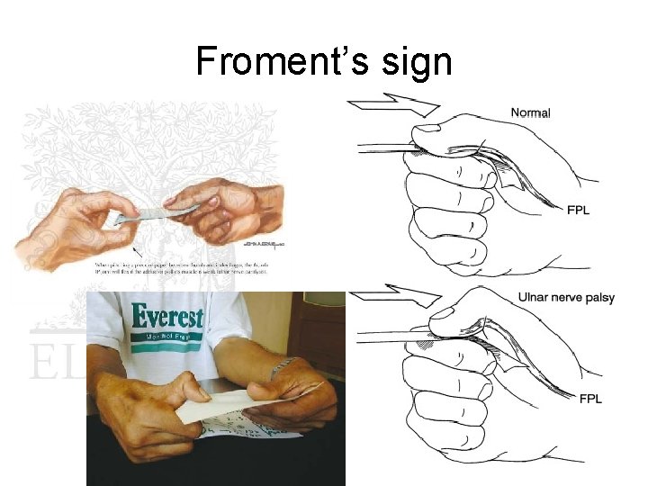 Froment’s sign 