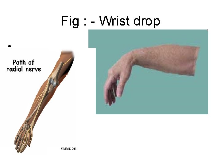 Fig : - Wrist drop • . 