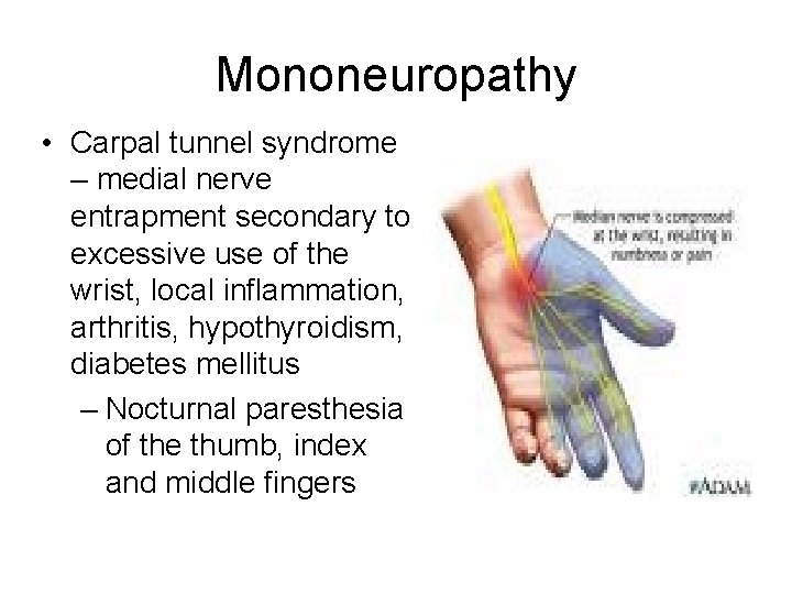 Mononeuropathy • Carpal tunnel syndrome – medial nerve entrapment secondary to excessive use of