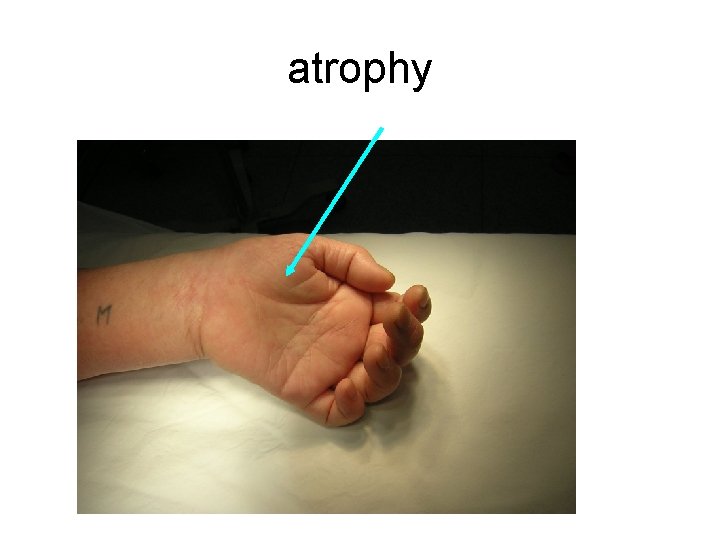 atrophy 