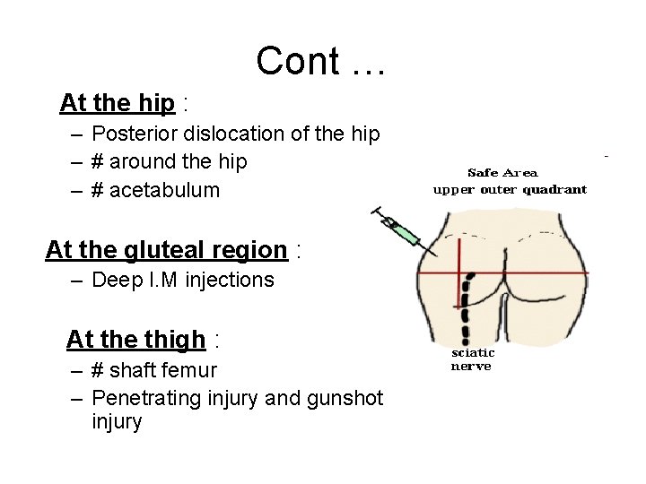 Cont … At the hip : – Posterior dislocation of the hip – #