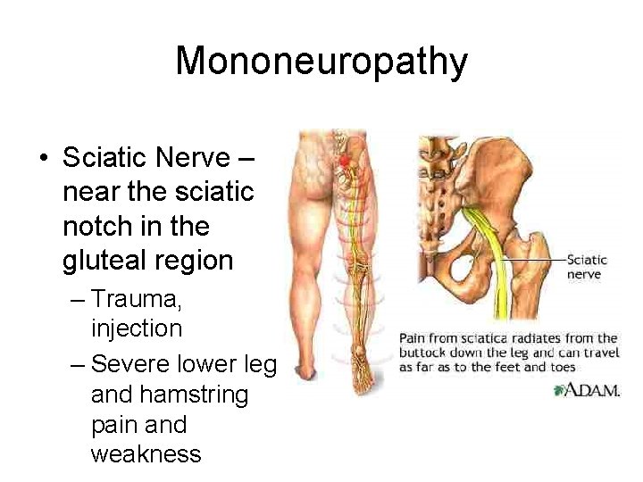 Mononeuropathy • Sciatic Nerve – near the sciatic notch in the gluteal region –