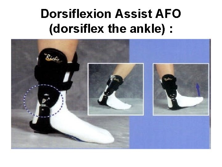 Dorsiflexion Assist AFO (dorsiflex the ankle) : 