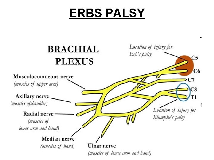 ERBS PALSY 