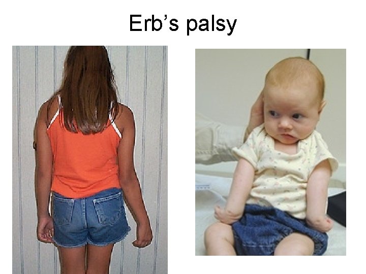 Erb’s palsy 