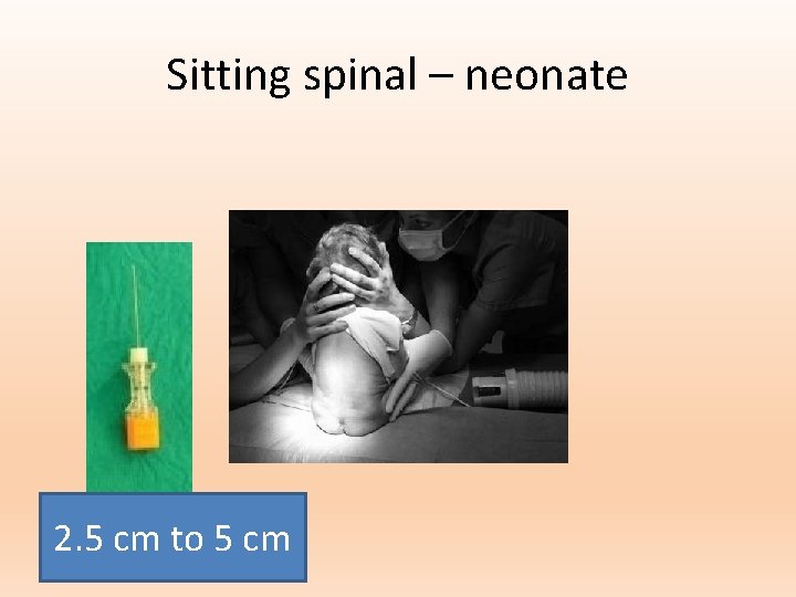 Sitting spinal – neonate 2. 5 cm to 5 cm 