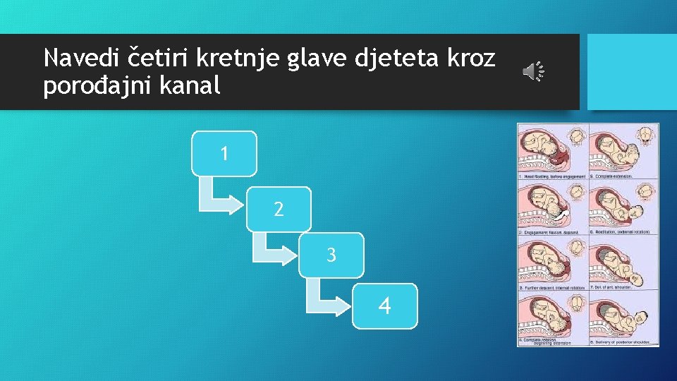 Navedi četiri kretnje glave djeteta kroz porođajni kanal 1 2 3 4 