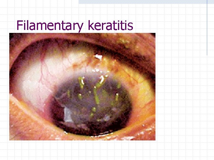 Filamentary keratitis 