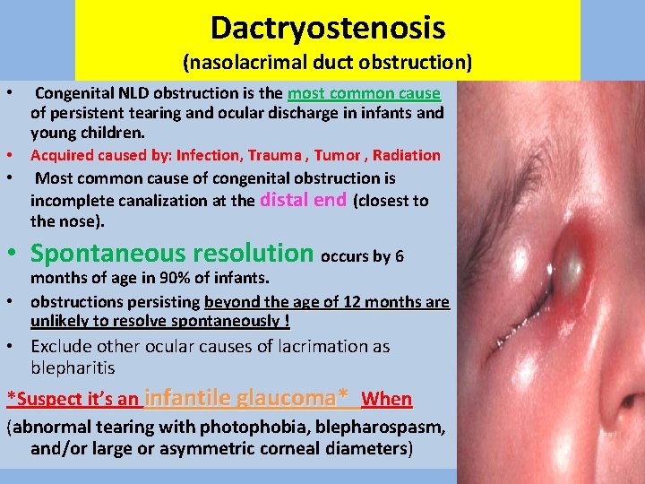 Dactryostenosis (nasolacrimal duct obstruction) • Congenital NLD obstruction is the most common cause of