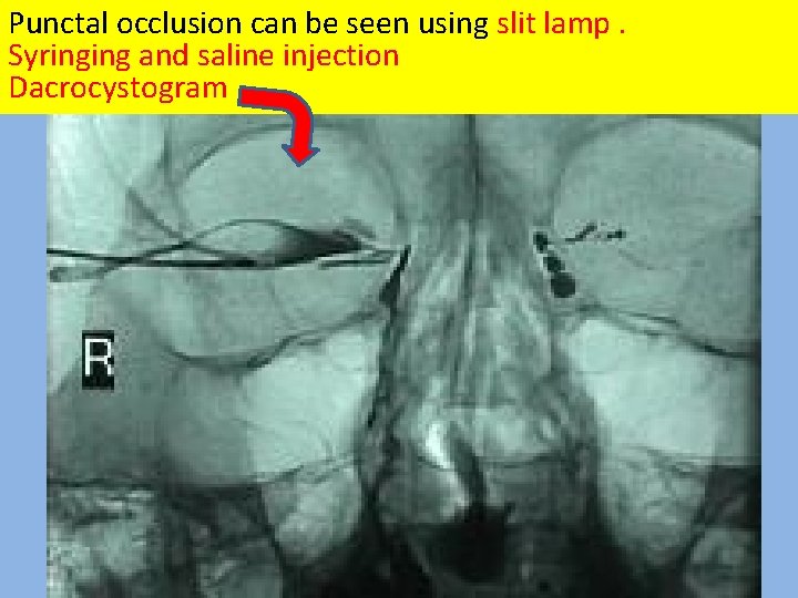 Punctal occlusion can be seen using slit lamp. Syringing and saline injection Dacrocystogram 