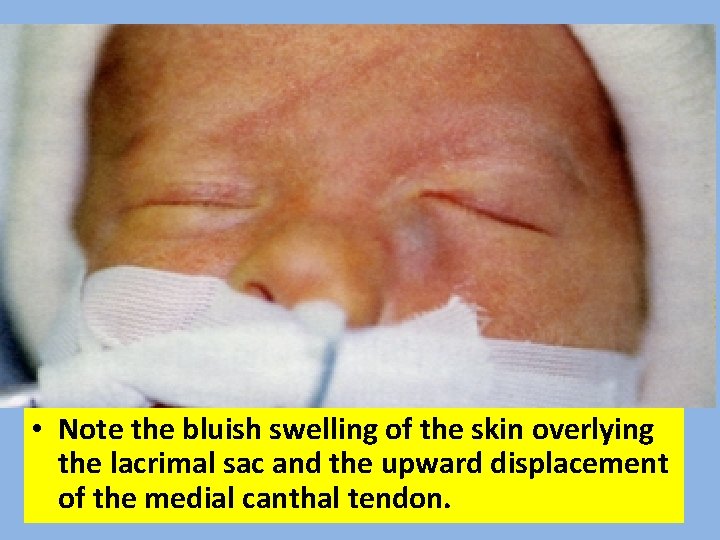  • Note the bluish swelling of the skin overlying the lacrimal sac and