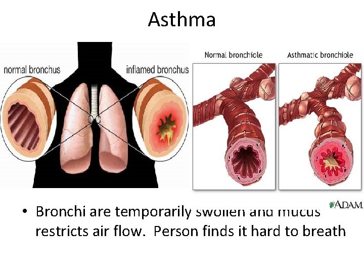 Asthma • Bronchi are temporarily swollen and mucus restricts air flow. Person finds it