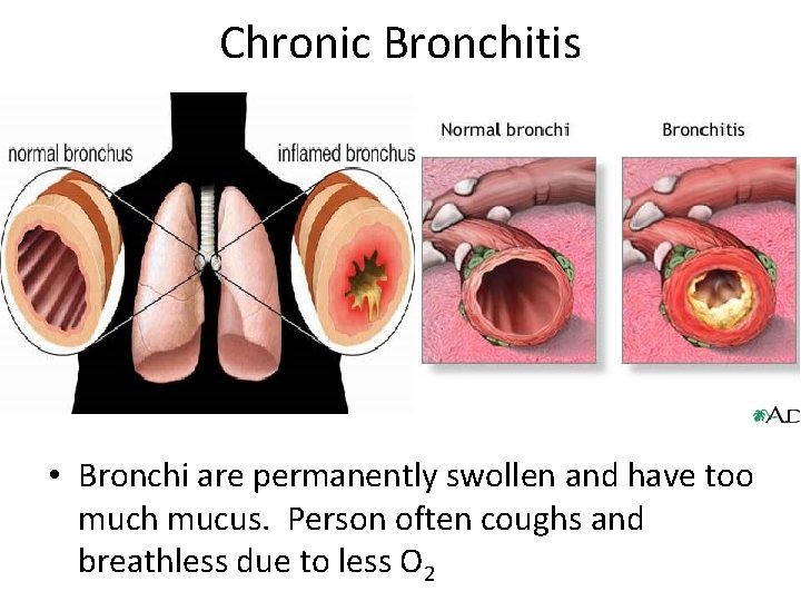 Chronic Bronchitis • Bronchi are permanently swollen and have too much mucus. Person often