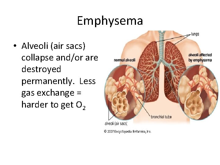 Emphysema • Alveoli (air sacs) collapse and/or are destroyed permanently. Less gas exchange =