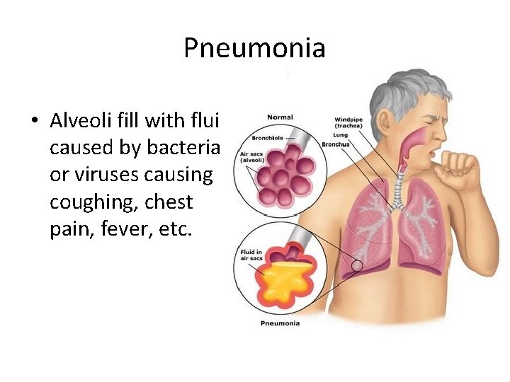 Pneumonia • Alveoli fill with fluid caused by bacteria or viruses causing coughing, chest