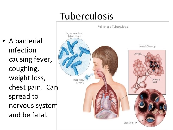 Tuberculosis • A bacterial infection causing fever, coughing, weight loss, chest pain. Can spread