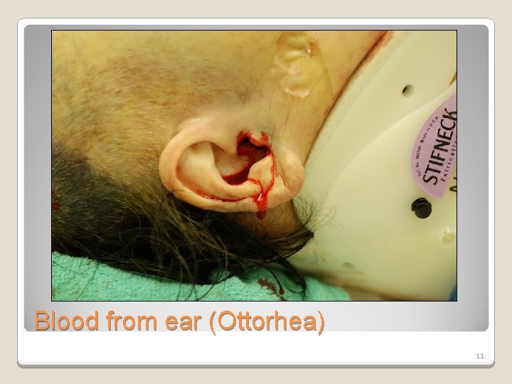 Blood from ear (Ottorhea) 11 