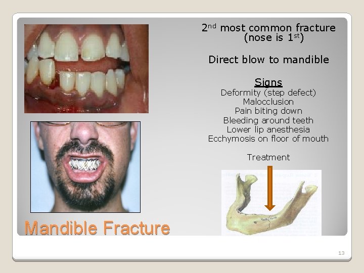 2 nd most common fracture (nose is 1 st) Direct blow to mandible Signs