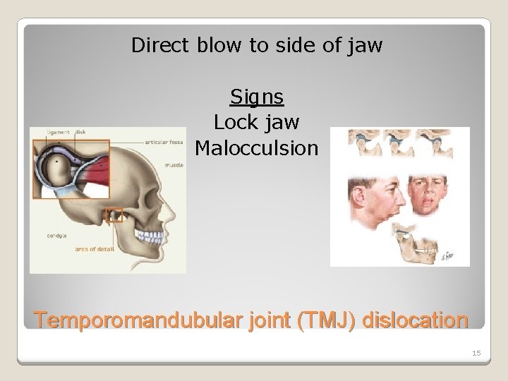 Direct blow to side of jaw Signs Lock jaw Malocculsion Temporomandubular joint (TMJ) dislocation