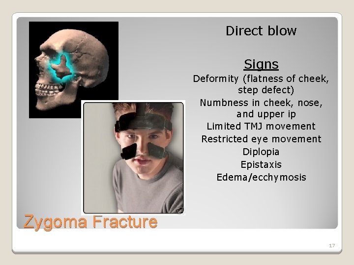 Direct blow Signs Deformity (flatness of cheek, step defect) Numbness in cheek, nose, and