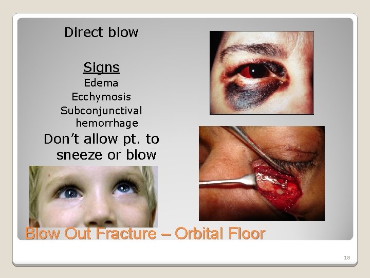Direct blow Signs Edema Ecchymosis Subconjunctival hemorrhage Don’t allow pt. to sneeze or blow