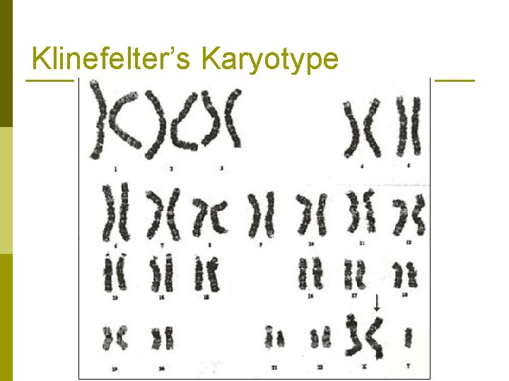 Klinefelter’s Karyotype 