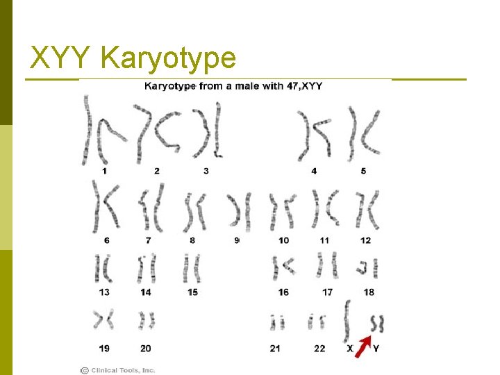 XYY Karyotype 