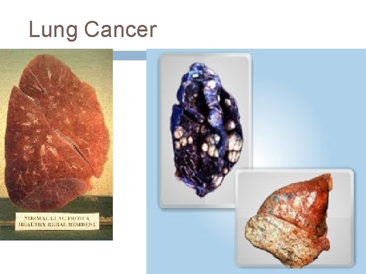 Lung Cancer Lung Cancer