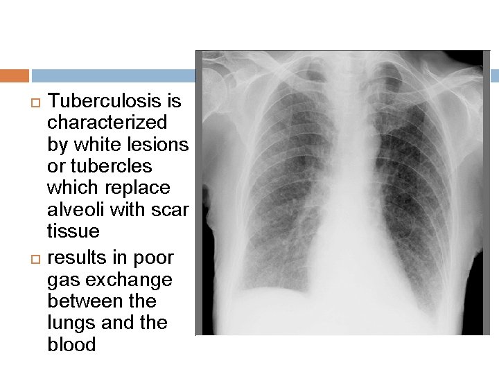 Tuberculosis is characterized by white lesions or tubercles which replace alveoli with scar Tuberculosis is characterized by white lesions or tubercles which replace alveoli with scar