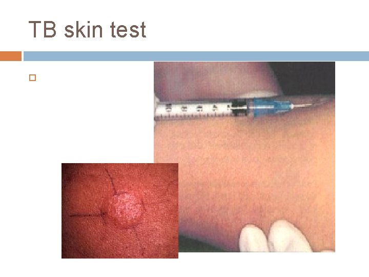 TB skin test TB skin test