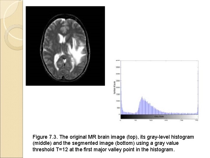 Figure 7. 3. The original MR brain image (top), its gray-level histogram (middle) and