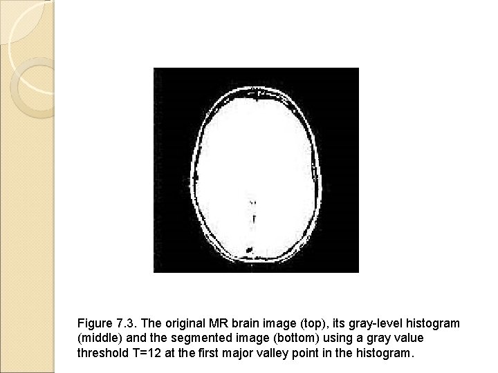 Figure 7. 3. The original MR brain image (top), its gray-level histogram (middle) and