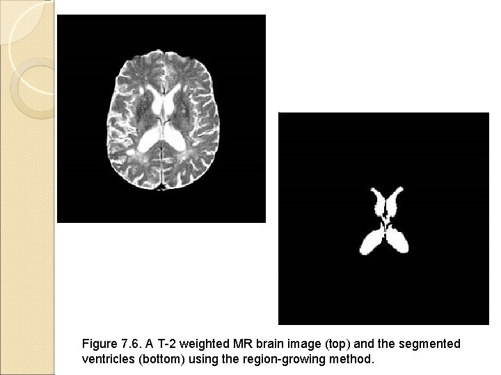 Figure 7. 6. A T-2 weighted MR brain image (top) and the segmented ventricles