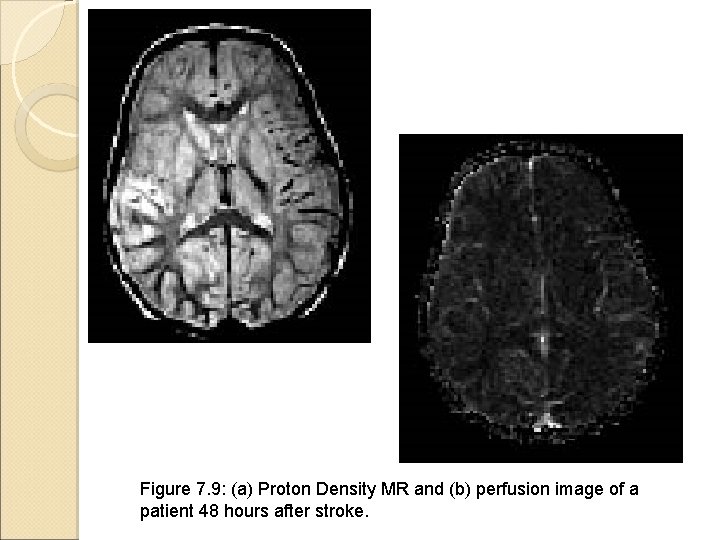 Figure 7. 9: (a) Proton Density MR and (b) perfusion image of a patient