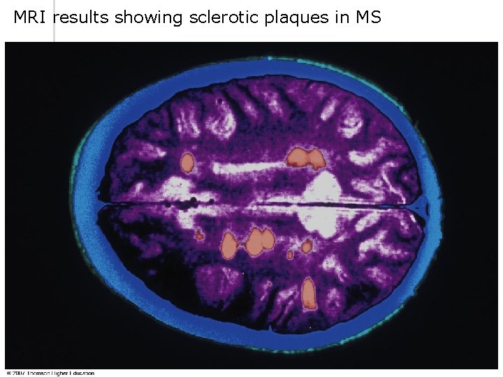 MRI results showing sclerotic plaques in MS © 2007 Thomson - Wadsworth 