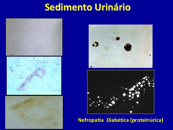 Sedimento Urinário Nefropatia Diabética (proteinúrica) 