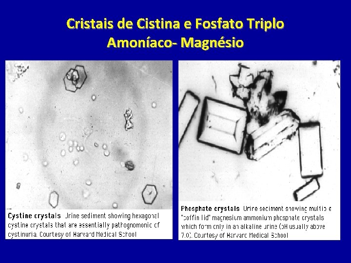 Cristais de Cistina e Fosfato Triplo Amoníaco- Magnésio 