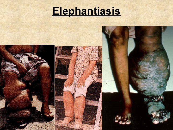 Elephantiasis 23 