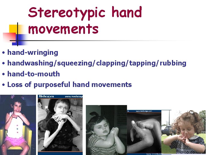 Stereotypic hand movements • hand-wringing • handwashing/squeezing/clapping/tapping/rubbing • hand-to-mouth • Loss of purposeful hand