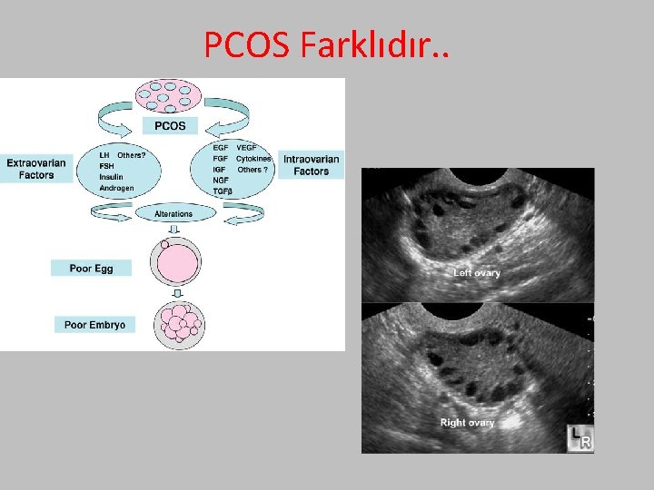 PCOS Farklıdır. . 