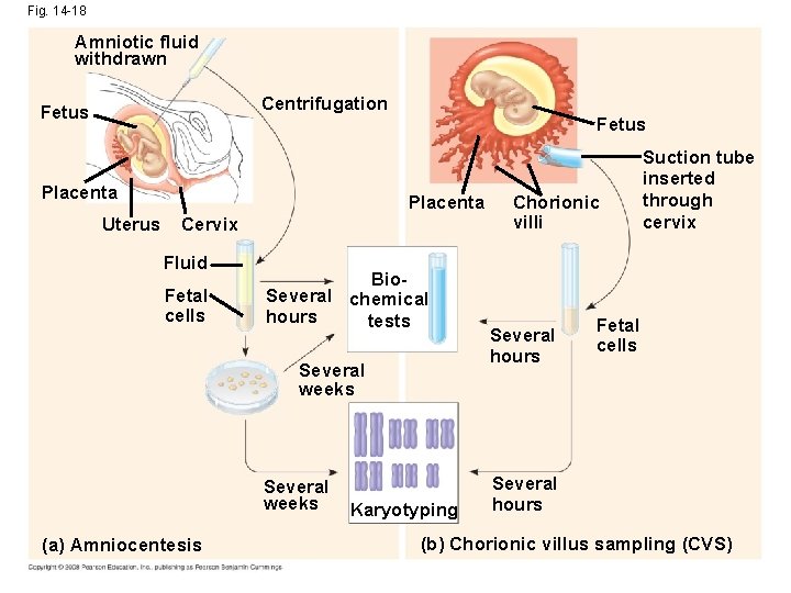 Fig. 14 -18 Amniotic fluid withdrawn Centrifugation Fetus Placenta Uterus Fetus Placenta Cervix Fluid