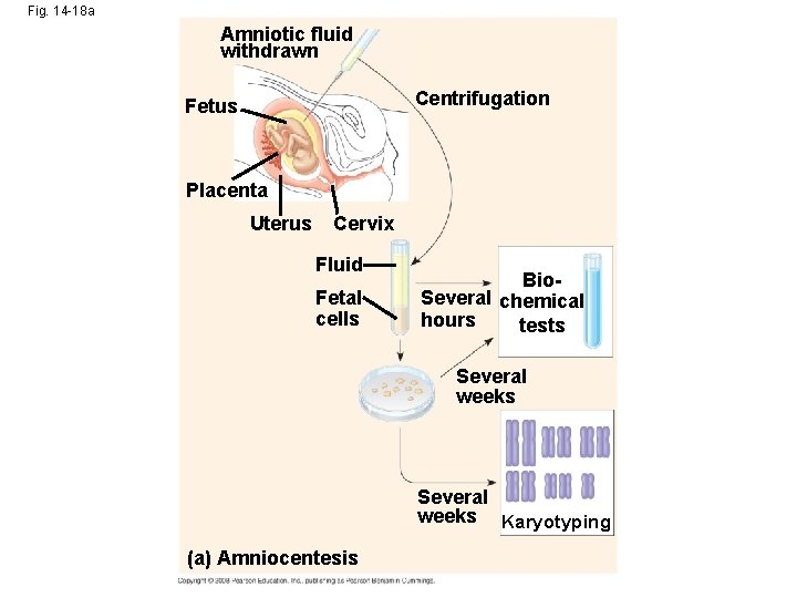 Fig. 14 -18 a Amniotic fluid withdrawn Centrifugation Fetus Placenta Uterus Cervix Fluid Fetal