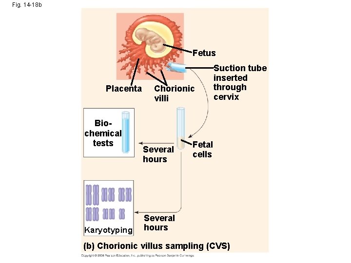 Fig. 14 -18 b Fetus Placenta Biochemical tests Karyotyping Chorionic villi Several hours Suction