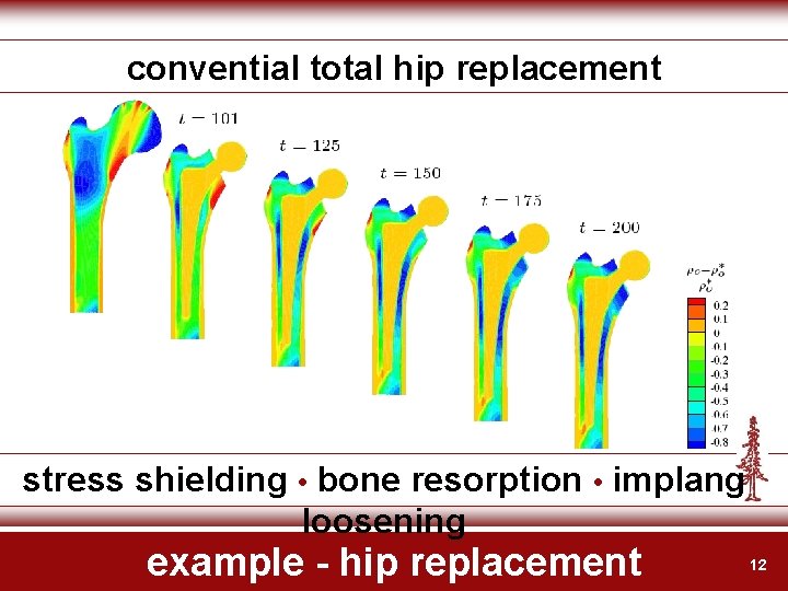 convential total hip replacement stress shielding • bone resorption • implang loosening example -