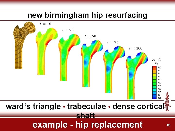 new birmingham hip resurfacing ward‘s triangle • trabeculae • dense cortical shaft example -