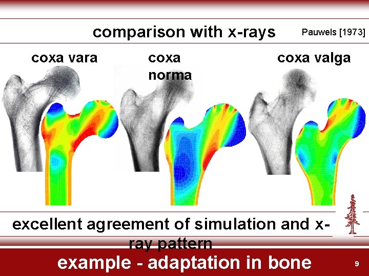 comparison with x-rays coxa vara coxa norma Pauwels [1973] coxa valga excellent agreement of