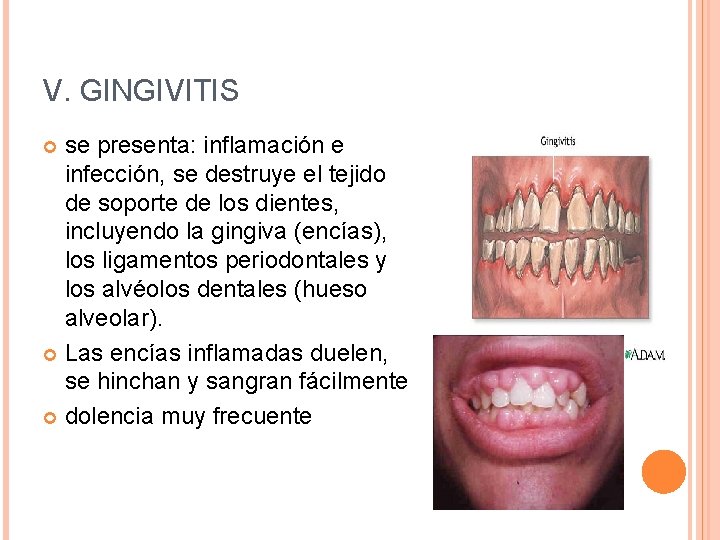 V. GINGIVITIS se presenta: inflamación e infección, se destruye el tejido de soporte de