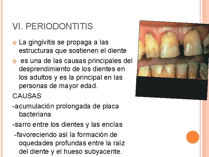 VI. PERIODONTITIS La gingivitis se propaga a las estructuras que sostienen el diente es